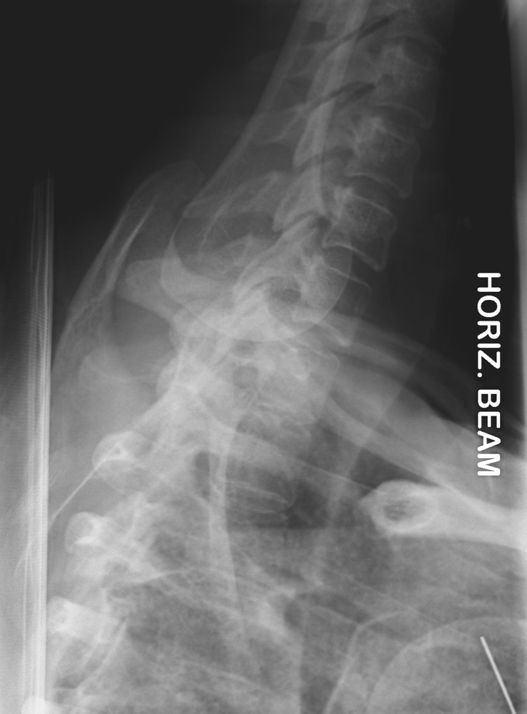 Cervical Spine Trauma Evaluation Spine Orthobullets